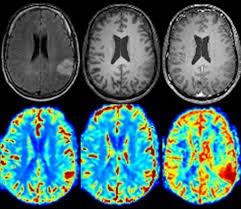 IRM fonctionnelle : comment interpréter les tâches rouges et les inférences statistiques associées